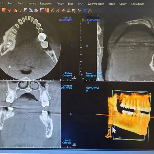 Dental 3D CT scan showing jawbone, teeth alignment, and implant planning with restoration and airway analysis.