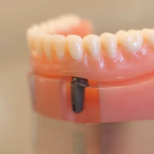Dental implant model showing artificial teeth and titanium screw in pink gum base.