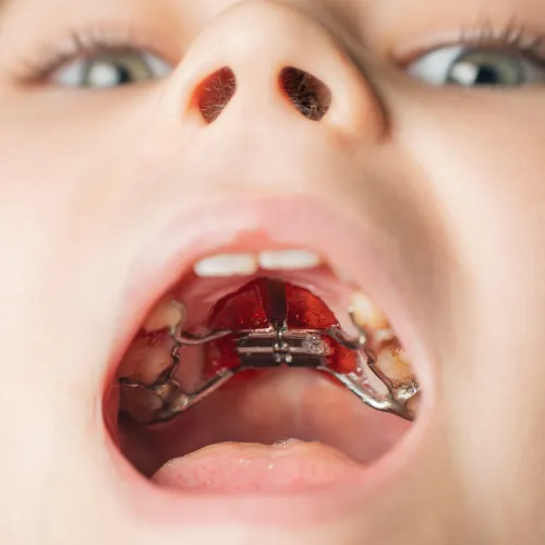 Close-up of a child's open mouth showing a dental palate expander appliance.