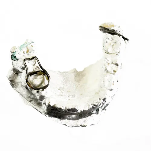 Dental mold of lower jaw with metal dental crown visible on one tooth isolated on white background