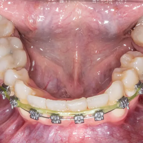 Close-up of lower teeth with metal braces and archwire inside the mouth on gums and teeth.