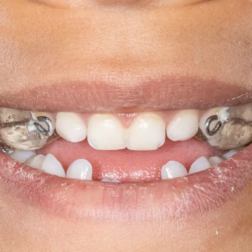 Close-up of a child's smile showing teeth with a dental appliance inside the mouth for orthodontic treatment.