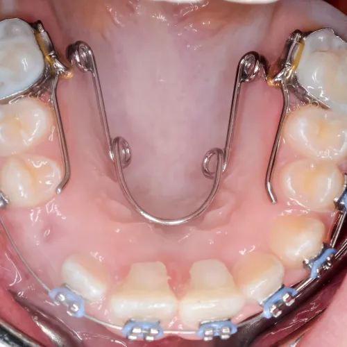 Close-up of lower teeth with braces and orthodontic appliance inside mouth for teeth alignment.