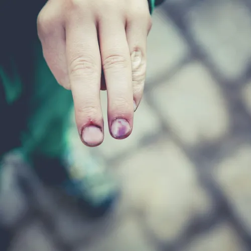 Close-up of two fingers with bruised and injured fingernails against a blurred stone pavement background.
