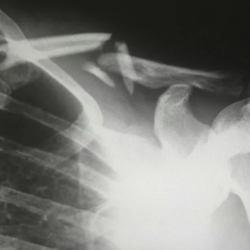 X-ray image showing a fractured clavicle near the shoulder with clear bone displacement visible.