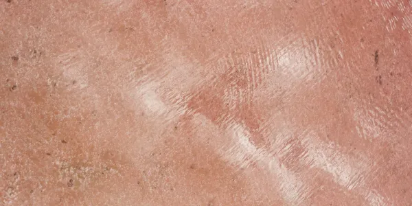 Image of Stretch Marks