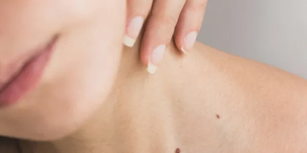 Image of Fine Lines and Wrinkles