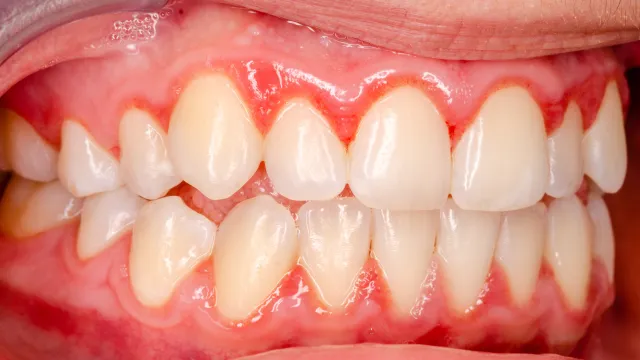 Close-up of human teeth and gums showing signs of gum inflammation and redness.
