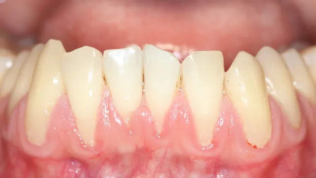 Close-up of lower front teeth showing plaque buildup and gum inflammation.