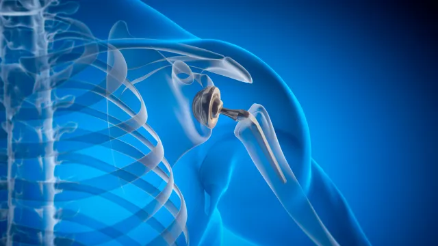 3D medical illustration of a shoulder joint with a prosthetic implant showing bones and replacement parts.