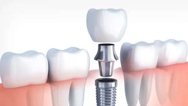 implant with crown