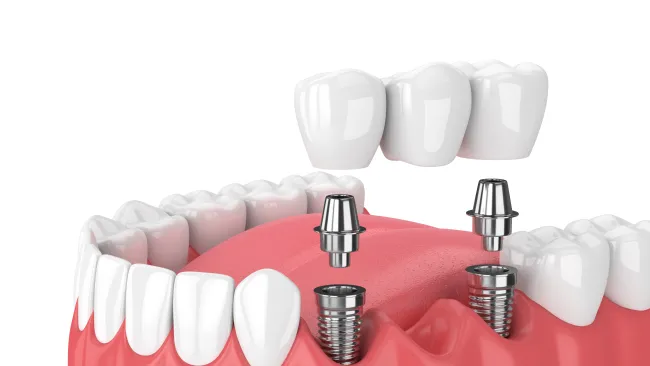 3D dental implant procedure showing titanium screws in gums supporting a three-tooth bridge.
