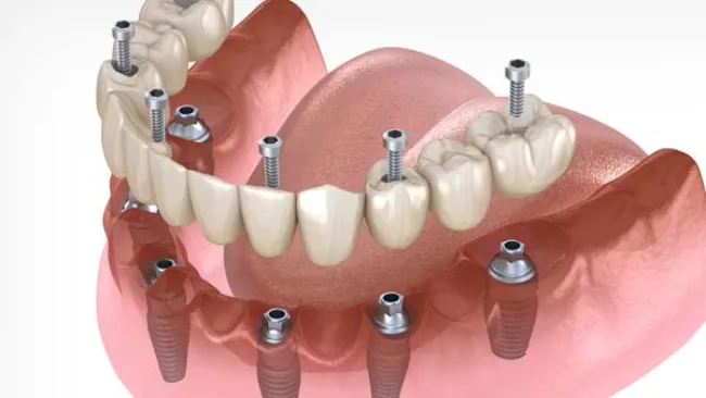 implant teeth secured with implants permanently