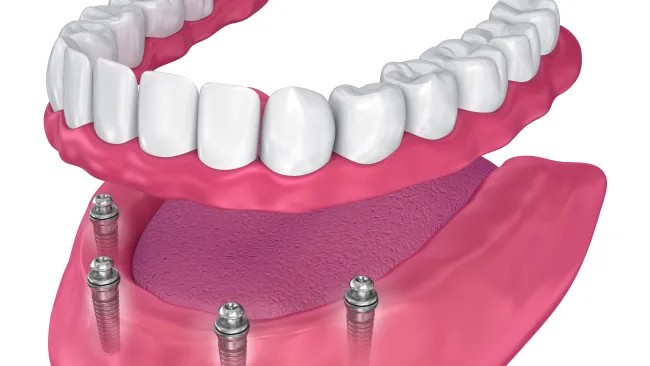 3D rendering of dental implants in lower jaw supporting a full set of prosthetic teeth with gums and tongue.