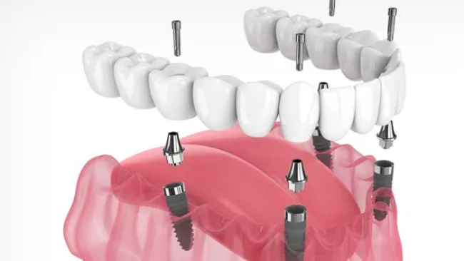 implant secured prosthesis with four implants