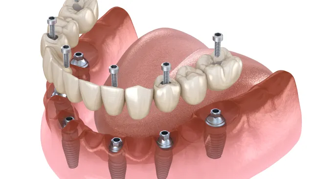 3D illustration of dental implant bridge secured with screws on lower jawbone showing teeth and gums.