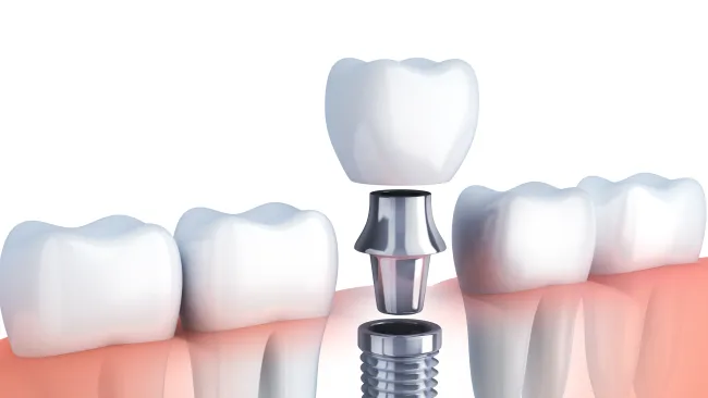 3D illustration of a dental implant with crown being placed between natural teeth in the gums