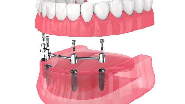 3D illustration of dental implants supporting a removable lower denture with upper natural teeth and gums