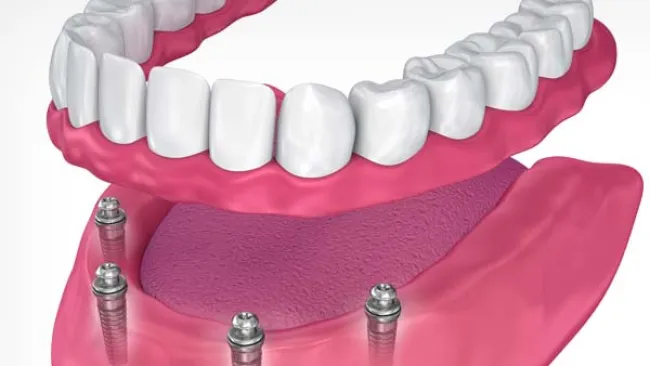 teeth placed in on snaps