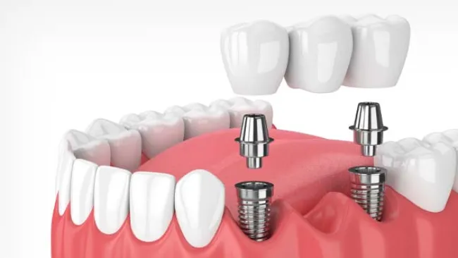 drawing of mouth with two implants and bridge
