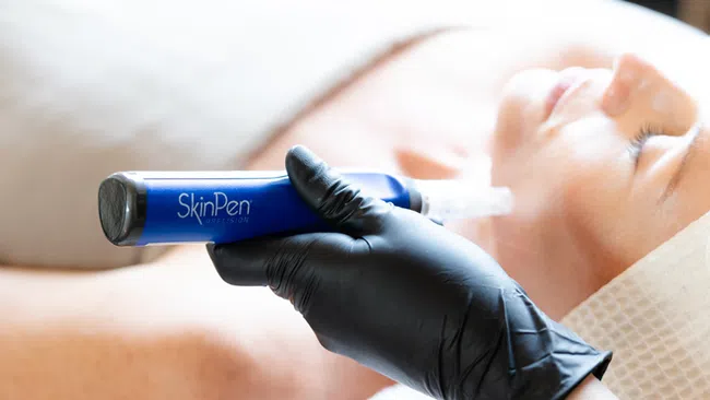 Close-up of a beauty professional using a SkinPen microneedling device on a relaxed woman's face.