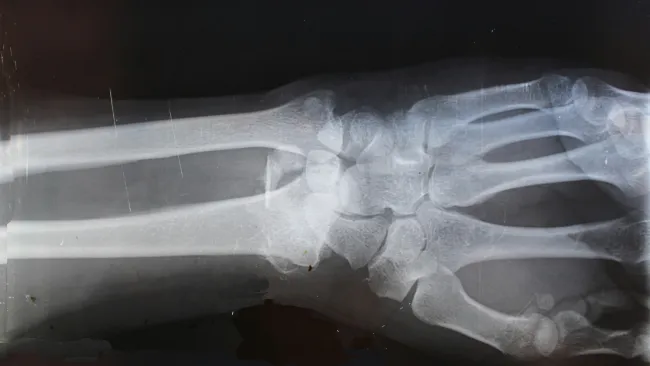 X-ray image showing the bones of a human wrist and lower forearm including radius and ulna.