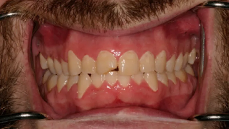 Close-up of a man's mouth showing crooked, yellowed teeth with dental cheek retractors in place