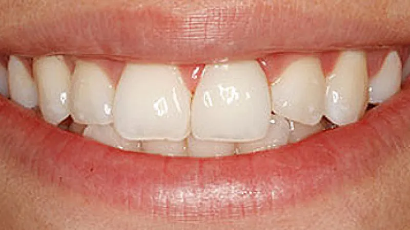 Close-up of a smiling mouth showing slightly spaced, clean, and healthy white teeth with natural gums.