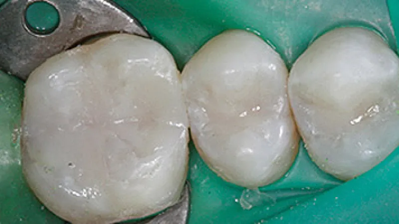 Close-up of three polished molar teeth with dental clamp and green rubber dam isolation in dental treatment.