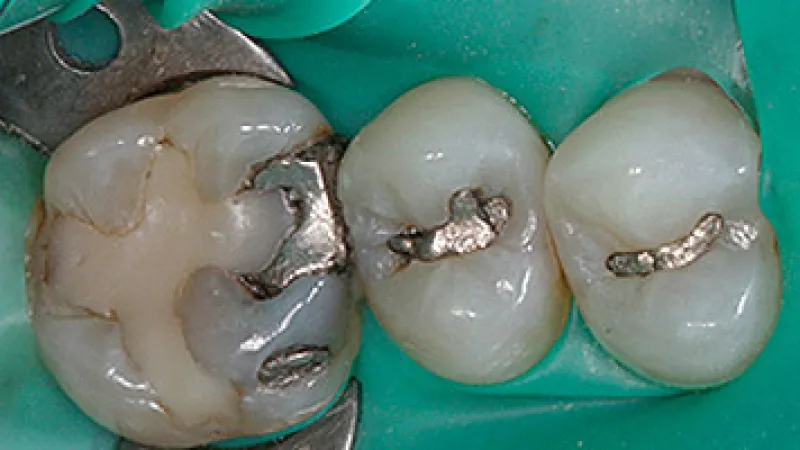 Close-up of molar teeth with old silver dental fillings and dental dam in place during treatment.
