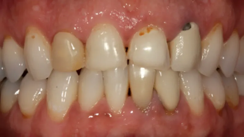 Close-up of human teeth showing discoloration, plaque buildup, and dental decay on upper front teeth.