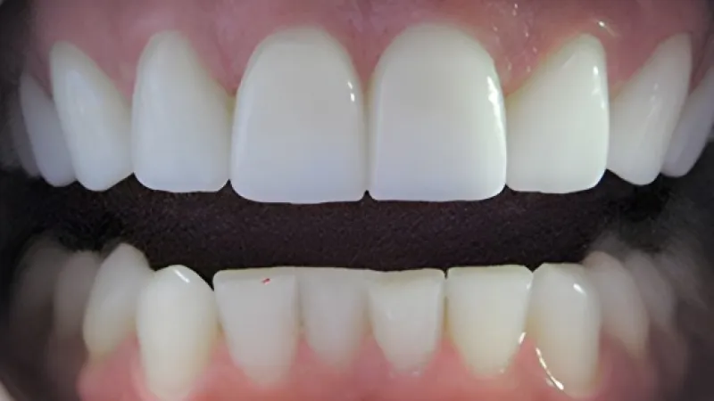 Close-up of upper and lower teeth showing dental alignment and tooth structure details.