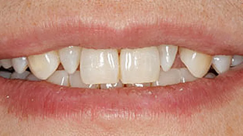 Close-up of human smile showing teeth with visible gaps and slight discoloration on some teeth.
