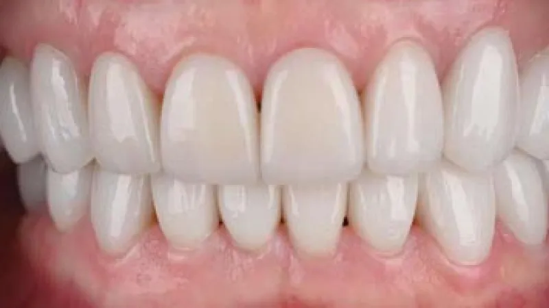 Close-up of bright white teeth showing healthy gums and perfect dental alignment in a natural smile