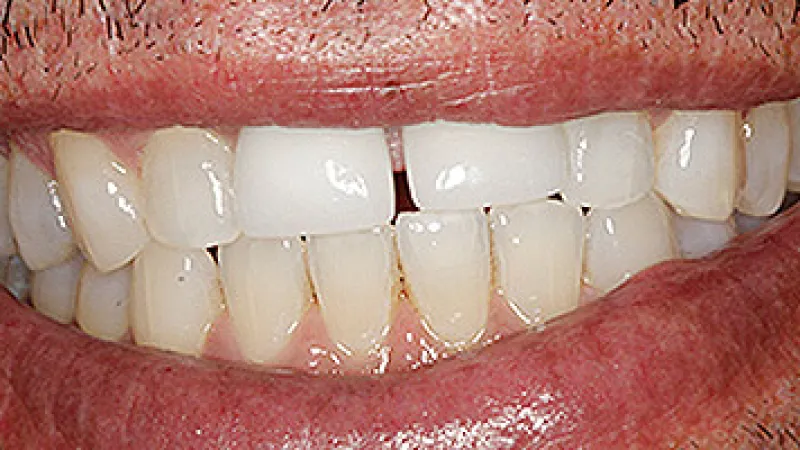 Close-up of a smiling mouth showing teeth with a noticeable white dental crown among natural teeth.