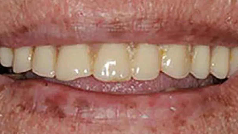 Close-up of a person's mouth showing stained and unevenly colored teeth with dry, cracked lips