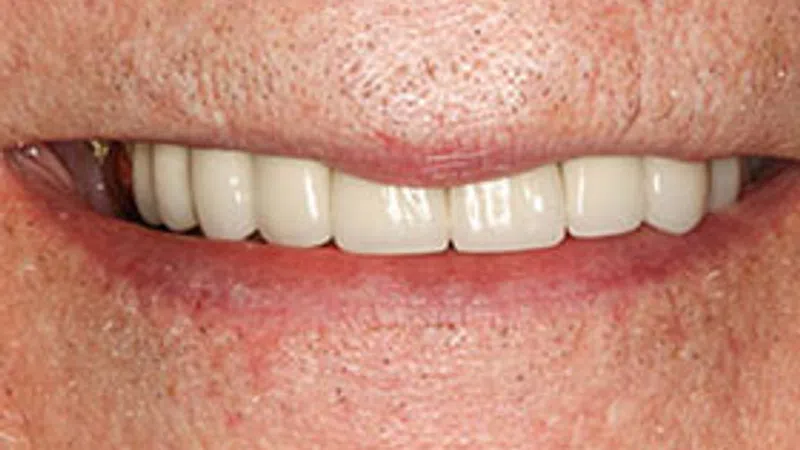 Close-up of a smiling mouth showing clean, white dental implants or dentures on a light skin tone.