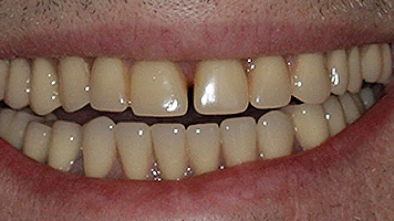 Close-up of a smile showing natural teeth with a slight gap between front teeth and mild discoloration.