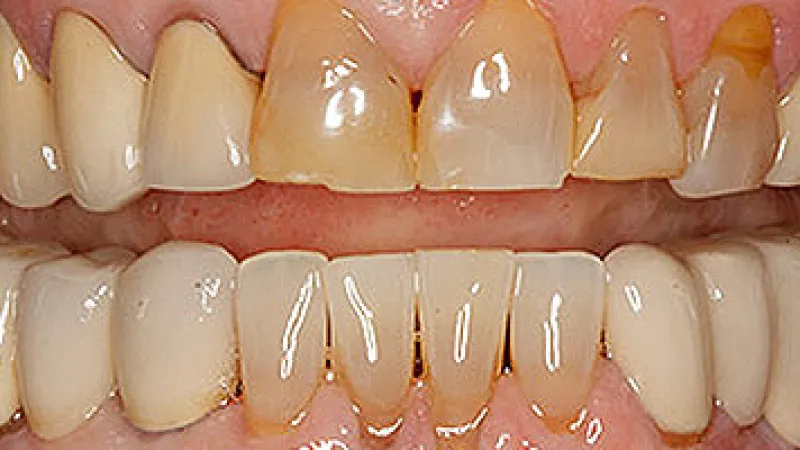 Close-up of upper and lower teeth showing discoloration, plaque buildup, and gum recession.