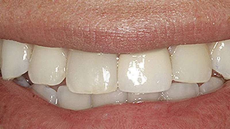Close-up of a smiling mouth showing clean, healthy white teeth and natural pink lips.