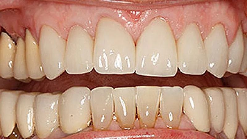 Close-up of upper and lower teeth showing dental crowns and yellowing on natural teeth.