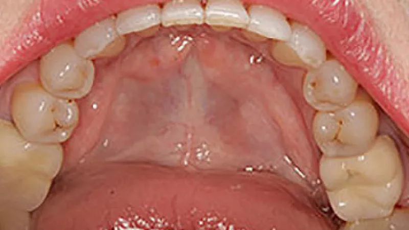 Close-up of an open mouth showing upper teeth and palate with natural tooth color and structure.