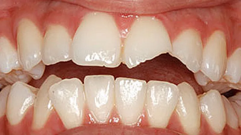 Close-up of broken upper front tooth with visible dental damage and surrounding healthy teeth and gums