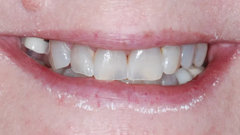 Close-up of a smile showing natural teeth with slight discoloration and lips with dry skin.