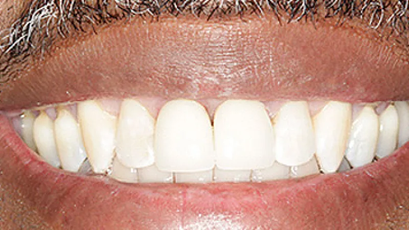 Close-up of a smiling mouth with clean, evenly aligned white teeth and facial stubble.