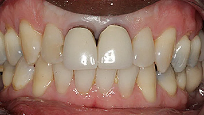 Close-up of human teeth showing dental crowns on upper front teeth with natural gums visible.