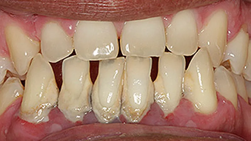 Close-up of crooked, stained teeth with visible plaque and gum inflammation, showing poor dental health.