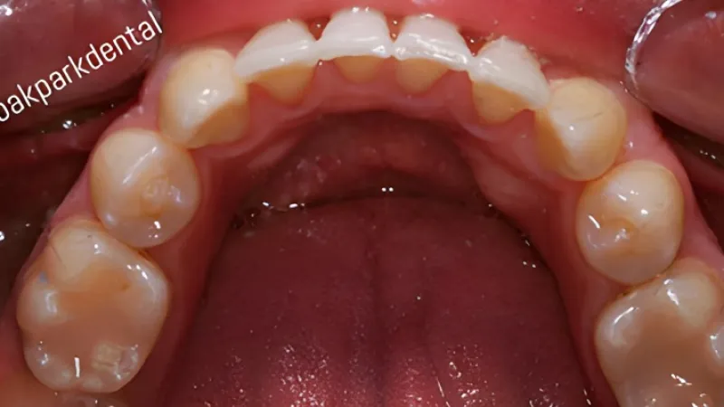 Close-up of upper teeth and gums inside a mouth showing dental anatomy and oral hygiene.