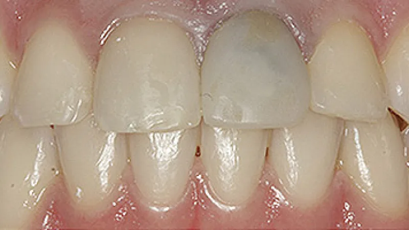 Close-up of healthy natural teeth and gums showing white incisors and canine teeth with smooth surfaces.