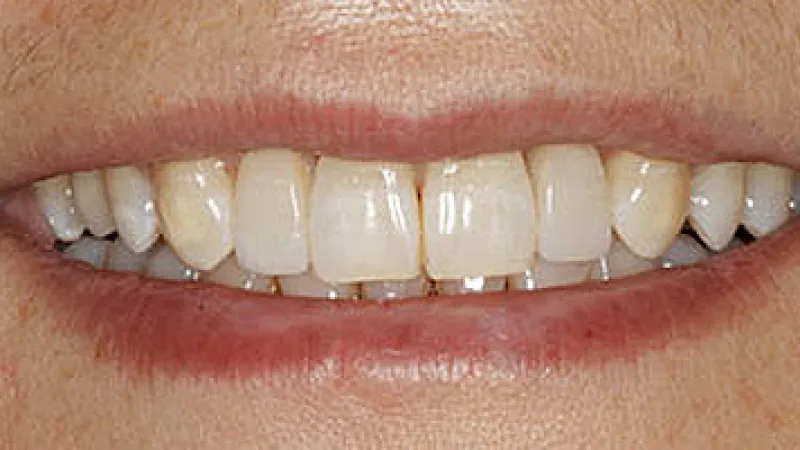 Close-up of a person's smile showing slightly yellowed teeth with a natural lip and skin tone.
